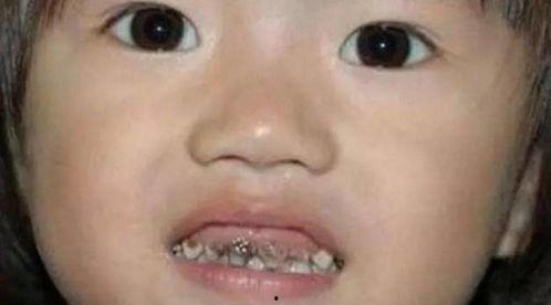 吃瓜把牙齿咬坏了,牙齿“咬”出健康危机 第1张 吃瓜把牙齿咬坏了,牙齿“咬”出健康危机 第1张